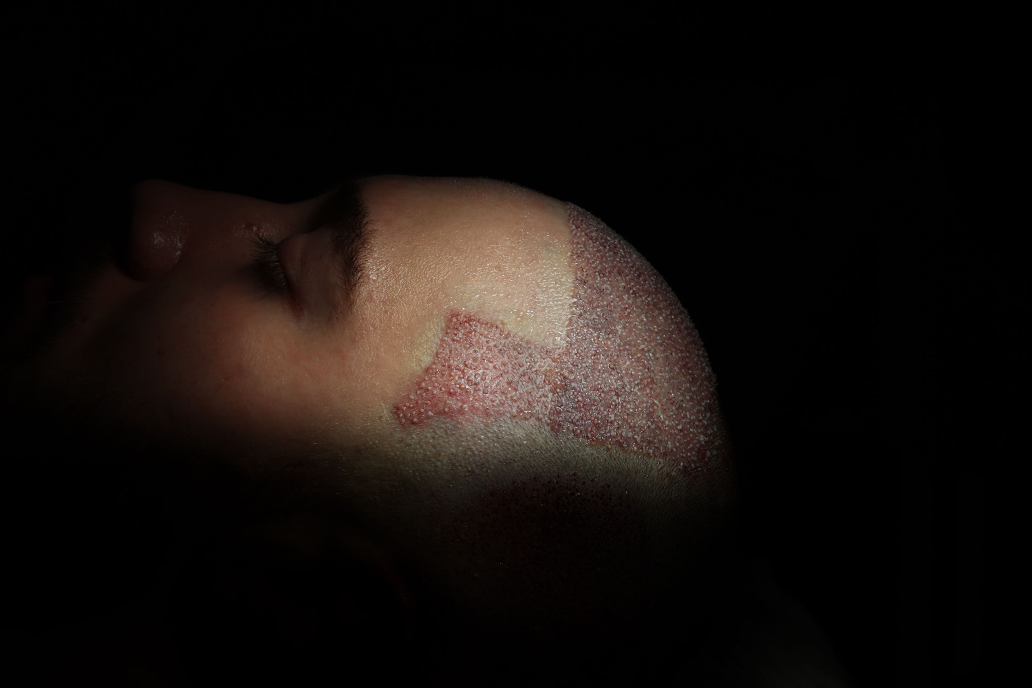 Hair transplant patient at Now Hair Time, Istanbul
