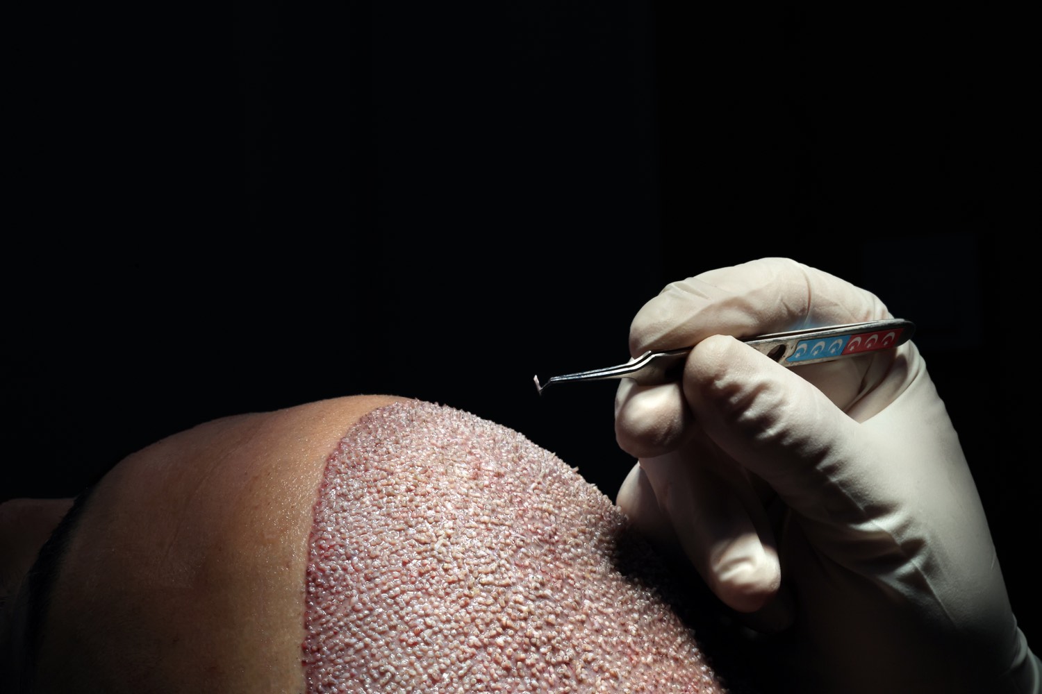 Hair transplant patient at Now Hair Time, Istanbul