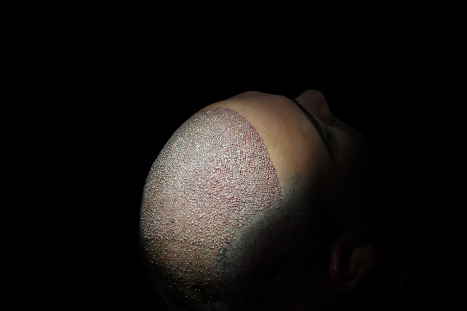Hair transplant patient at Now Hair Time, Istanbul