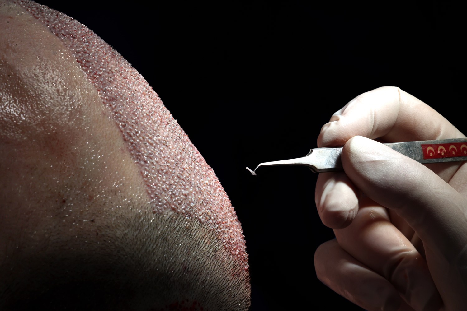 Hair transplant patient at Now Hair Time, Istanbul