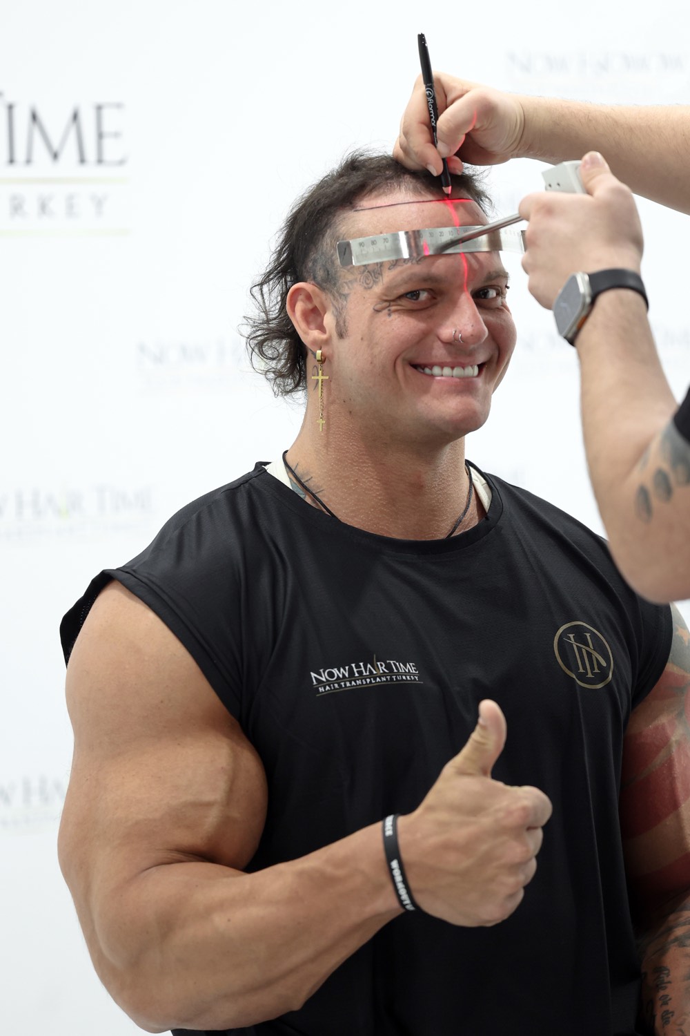 Paciente de transplante capilar na Now Hair Time, Istambul