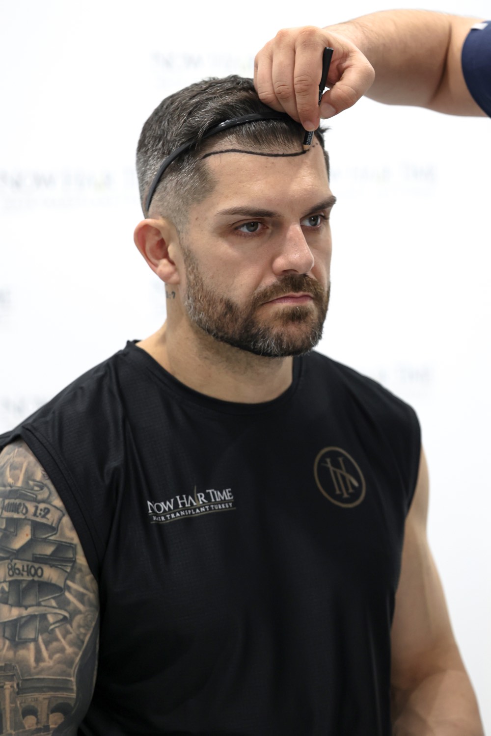 Paciente de transplante capilar na Now Hair Time, Istambul