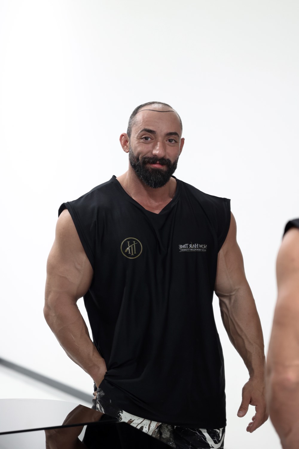 Hair transplant patient at Now Hair Time, Istanbul