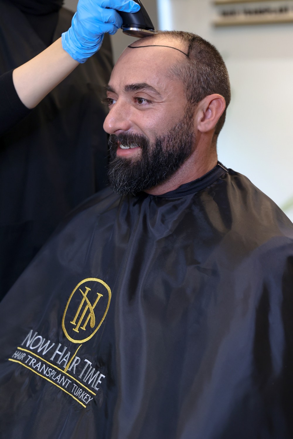 Hair transplant patient at Now Hair Time, Istanbul