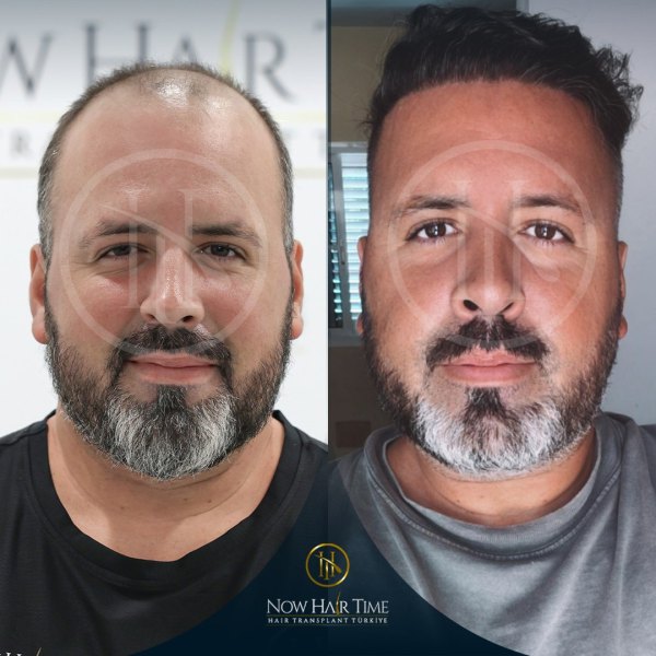 121