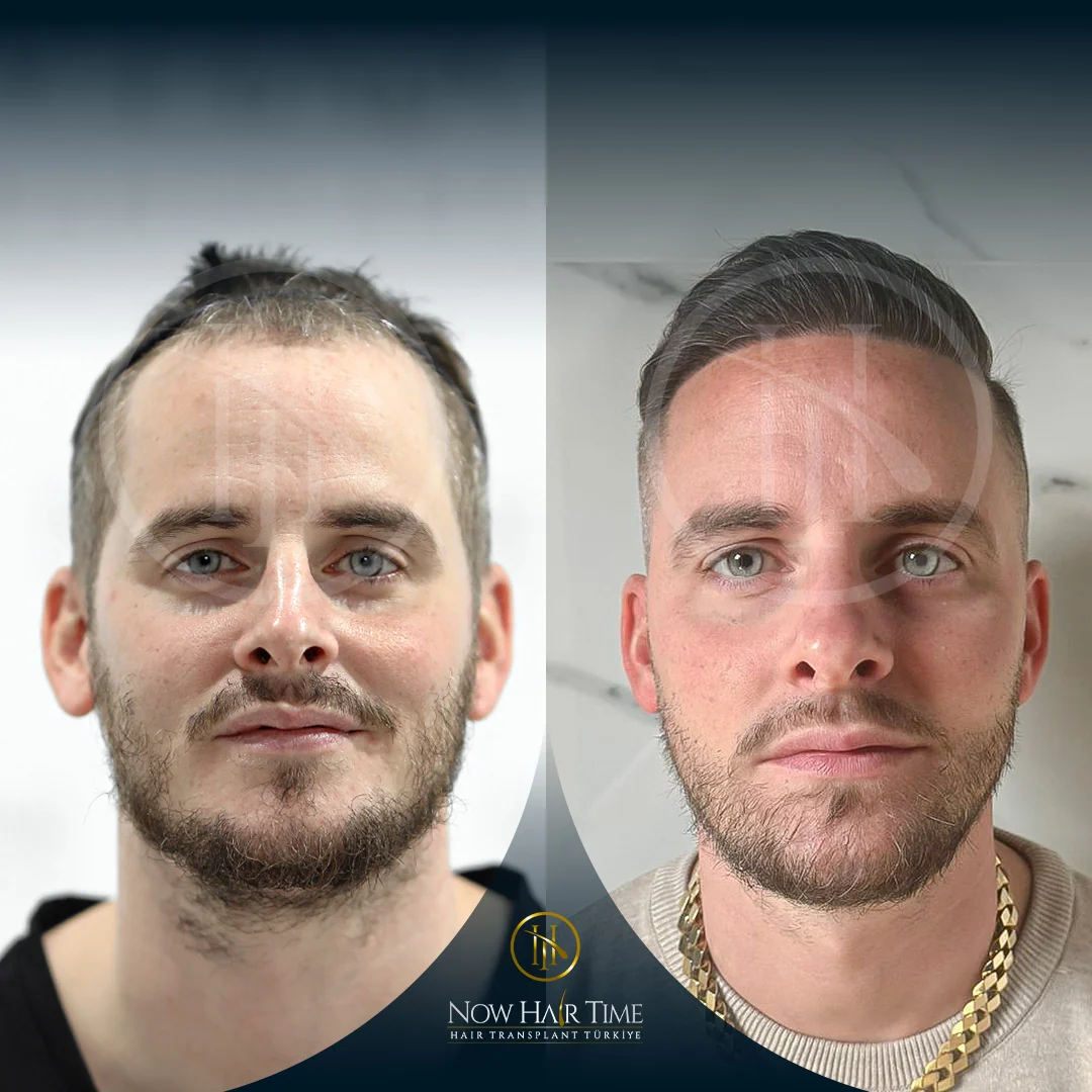 Hair & Beard Transplant — Now Hair Time