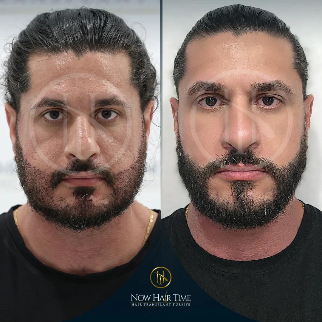 Beard Transplant — Now Hair Time