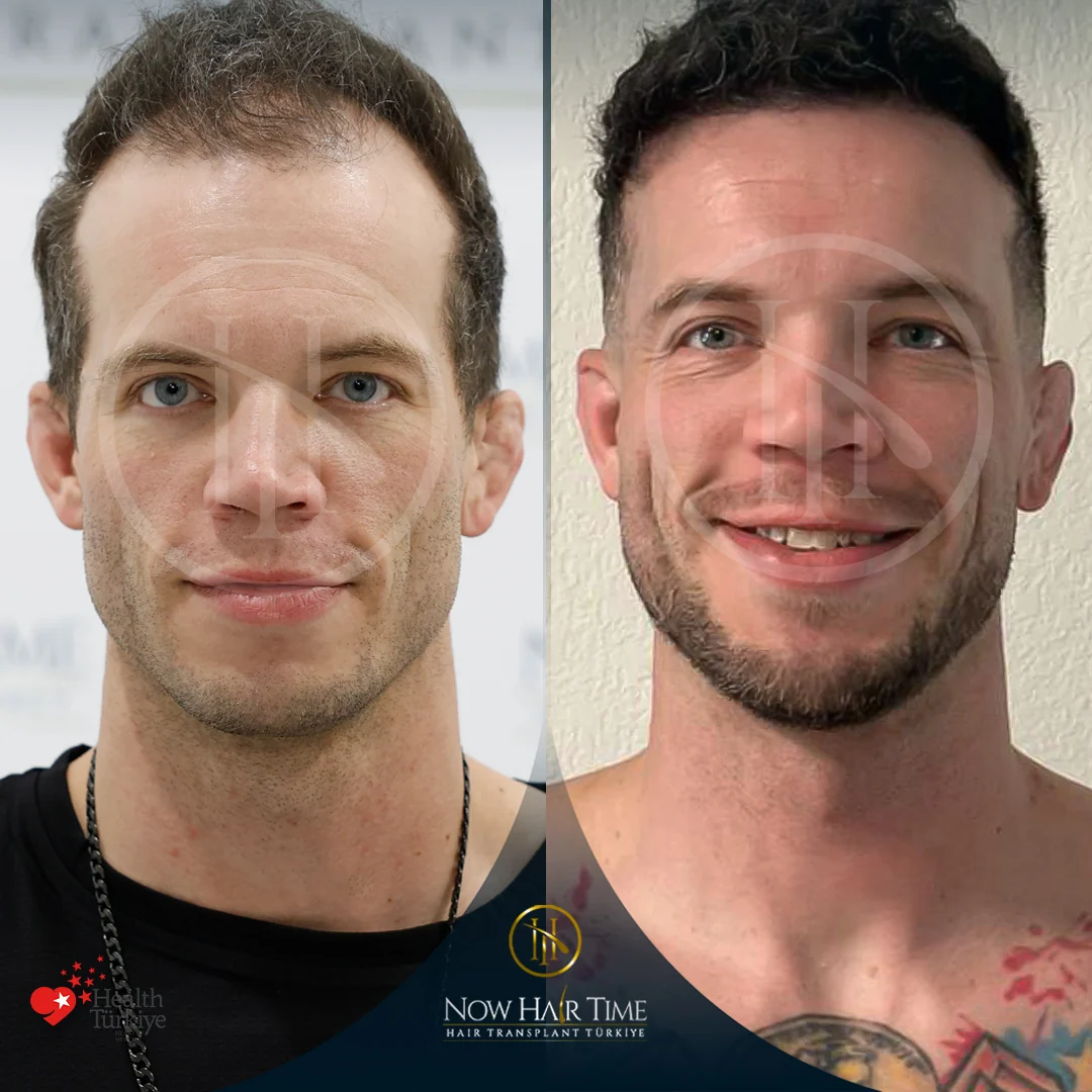 Hair Transplant — Now Hair Time