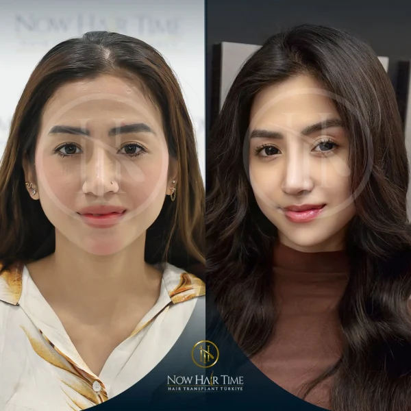 Female Hair Transplant — Now Hair Time