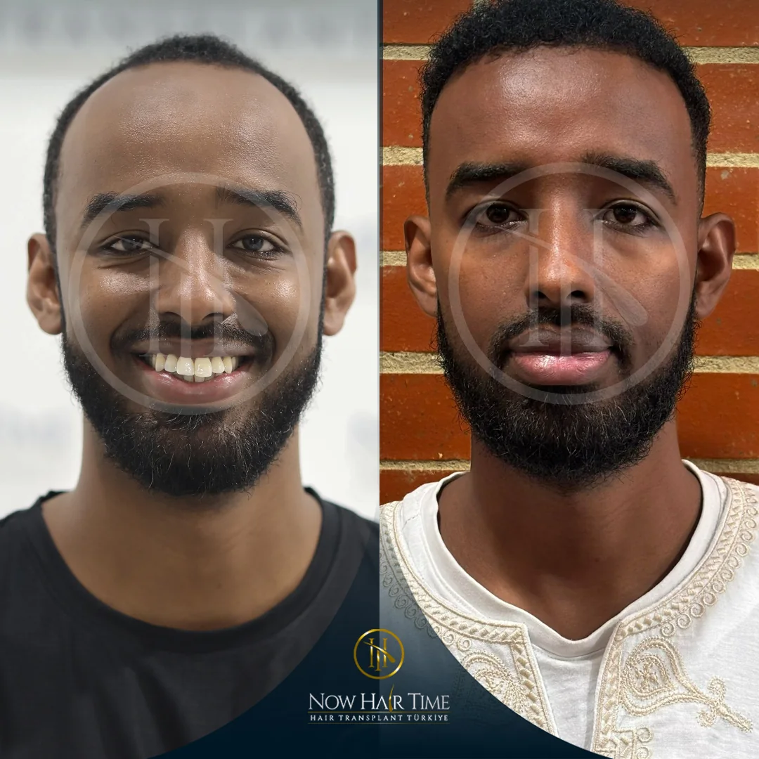 Afro Hair Transplant — Now Hair Time
