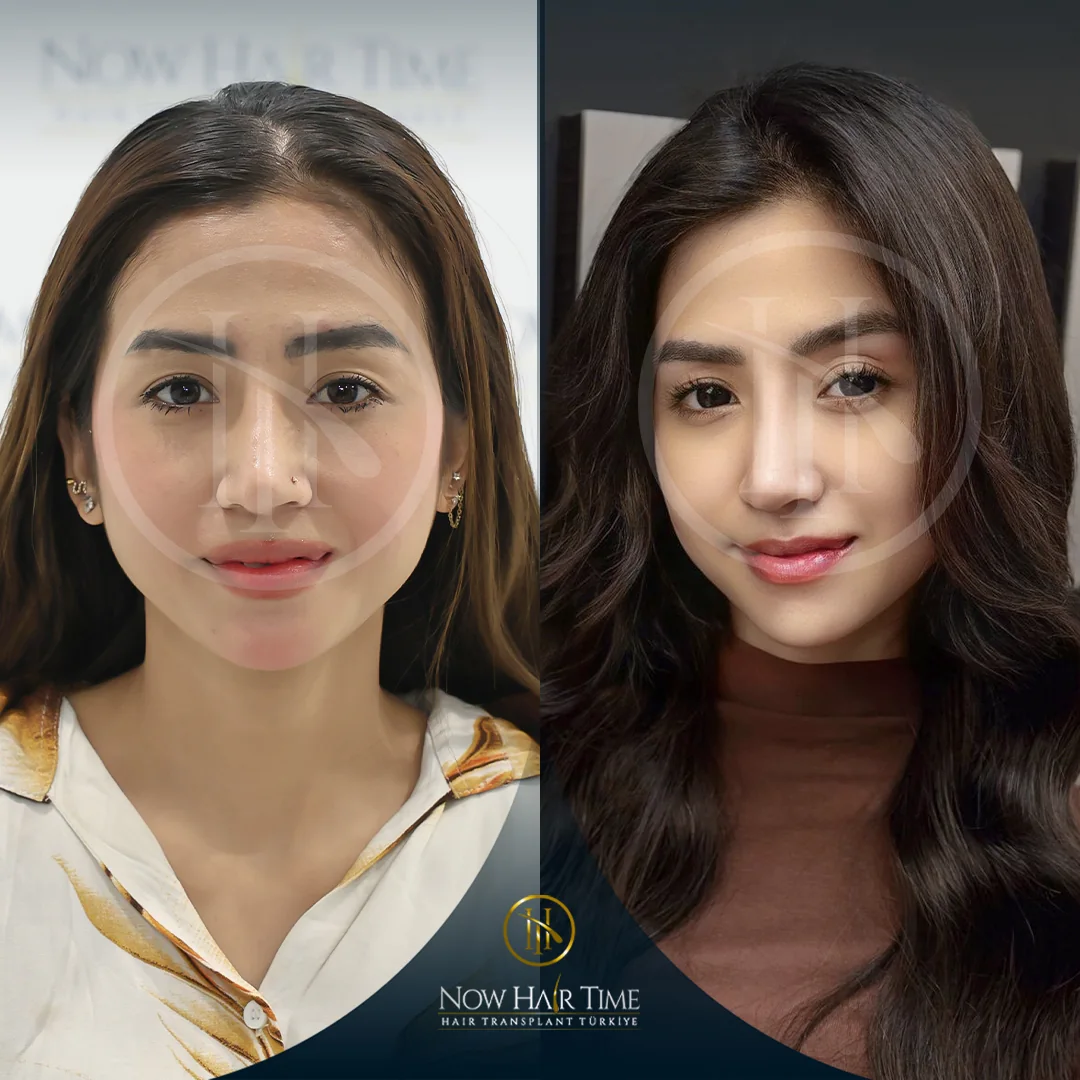 Female Hair Transplant — Now Hair Time