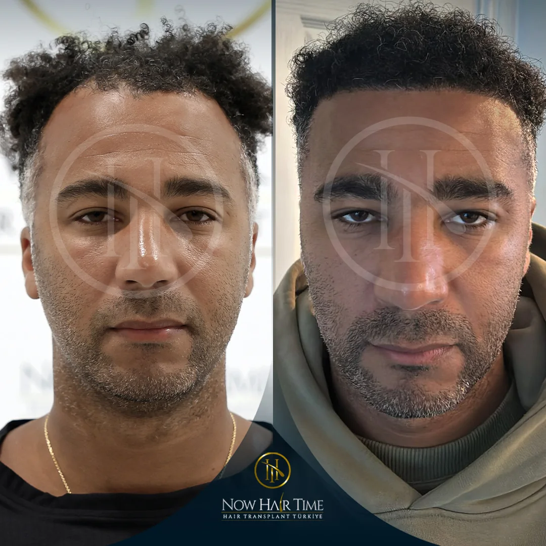Afro Hair Transplant — Now Hair Time