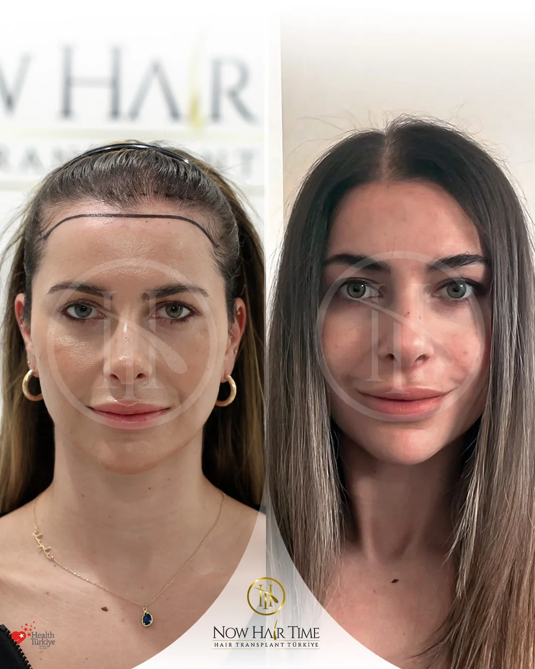 Female Hair Transplant — Now Hair Time