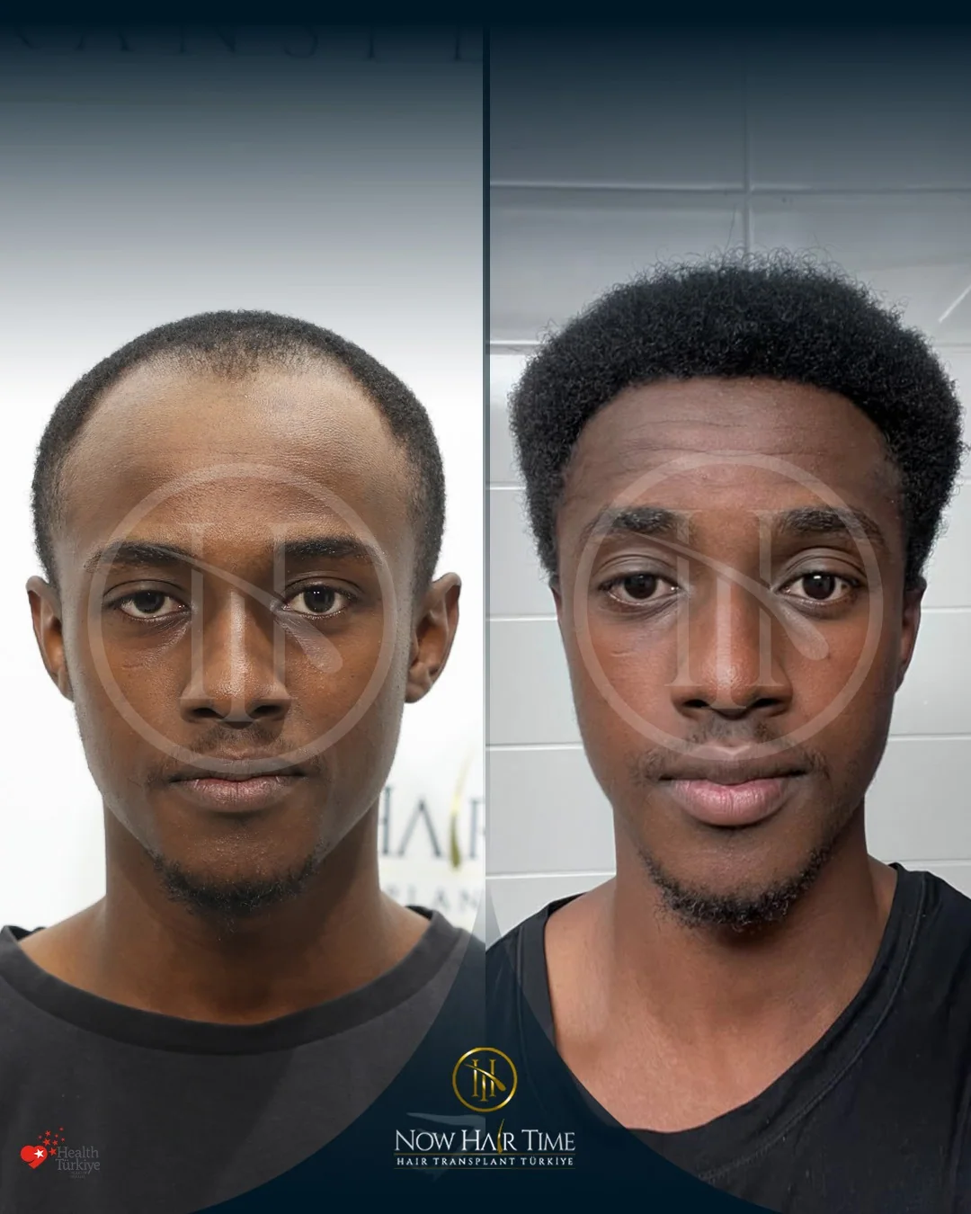 Afro Hair Transplant — Now Hair Time