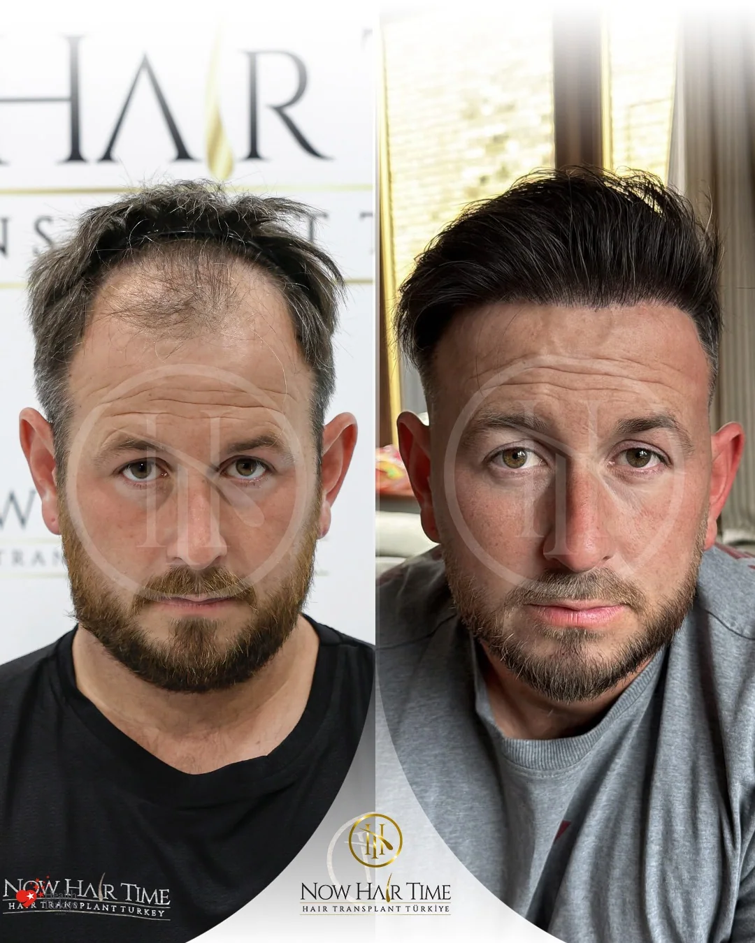 Hair Transplant — Now Hair Time