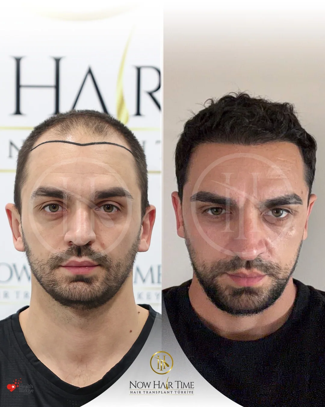 Hair Transplant — Now Hair Time