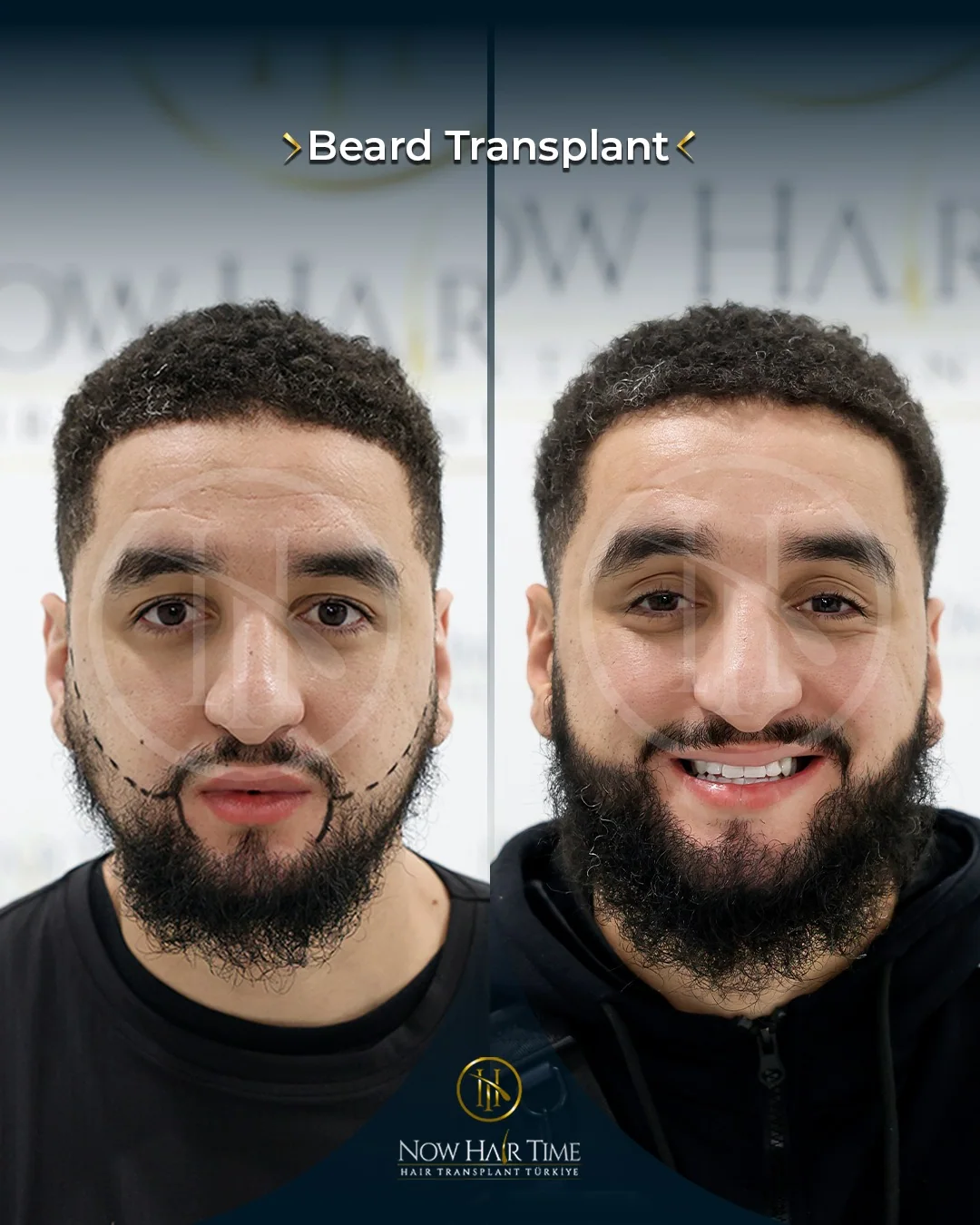 Beard Transplant — Now Hair Time