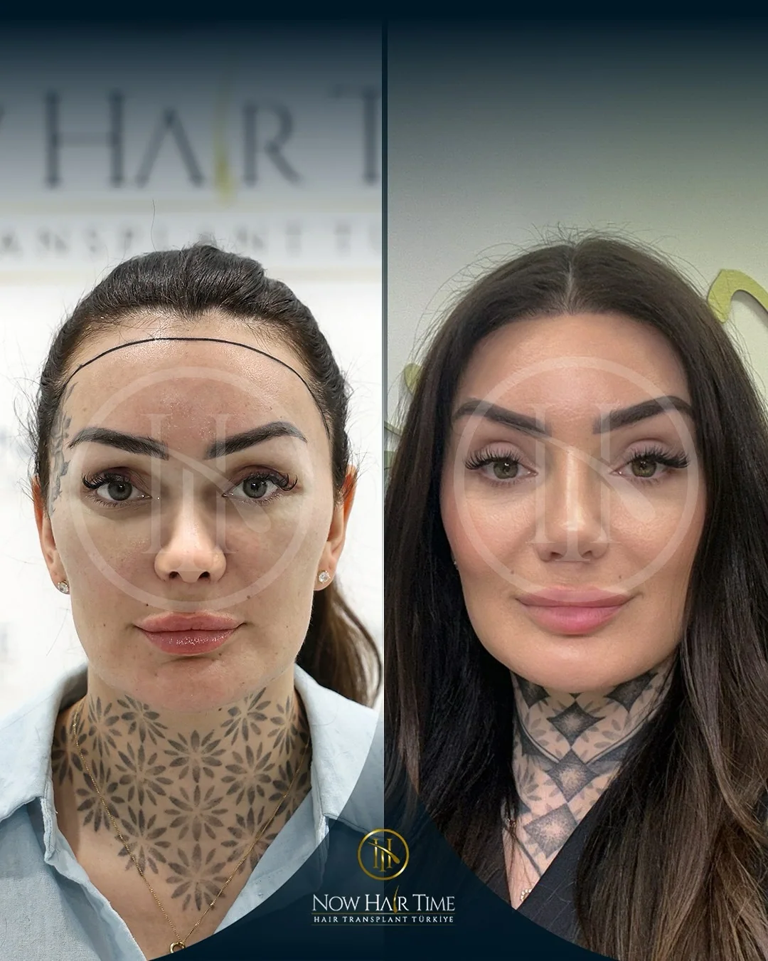 Female Hair Transplant — Now Hair Time