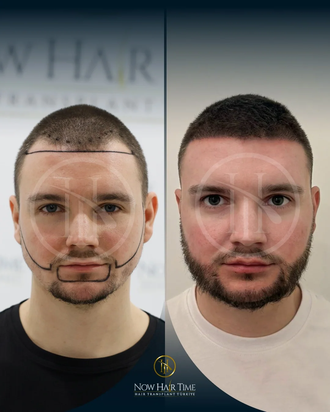Hair & Beard Transplant — Now Hair Time
