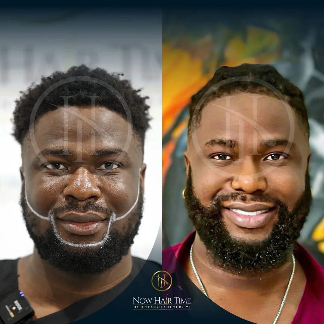 Beard Transplant — Now Hair Time