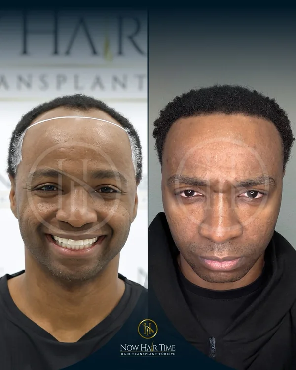 Afro Hair Transplant — Now Hair Time