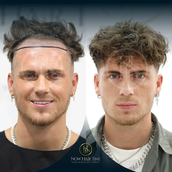 Hair Transplant — Now Hair Time