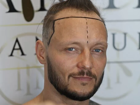 haartransplantation-turkei-kosten-2.webp