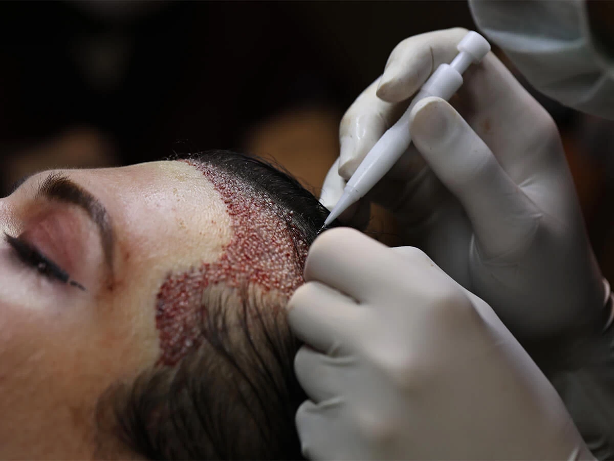 dhi-hair-transplant-in-turkey.webp
