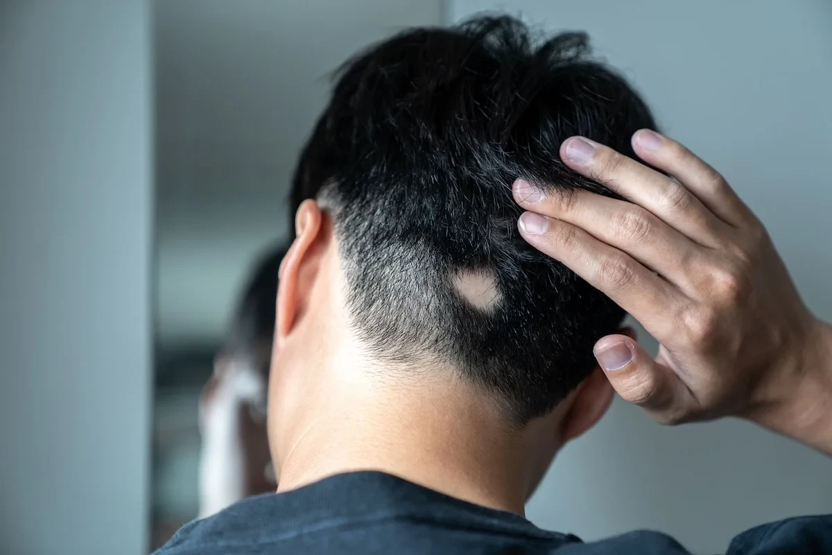 Can Tight Hairstyles Cause Alopecia?
