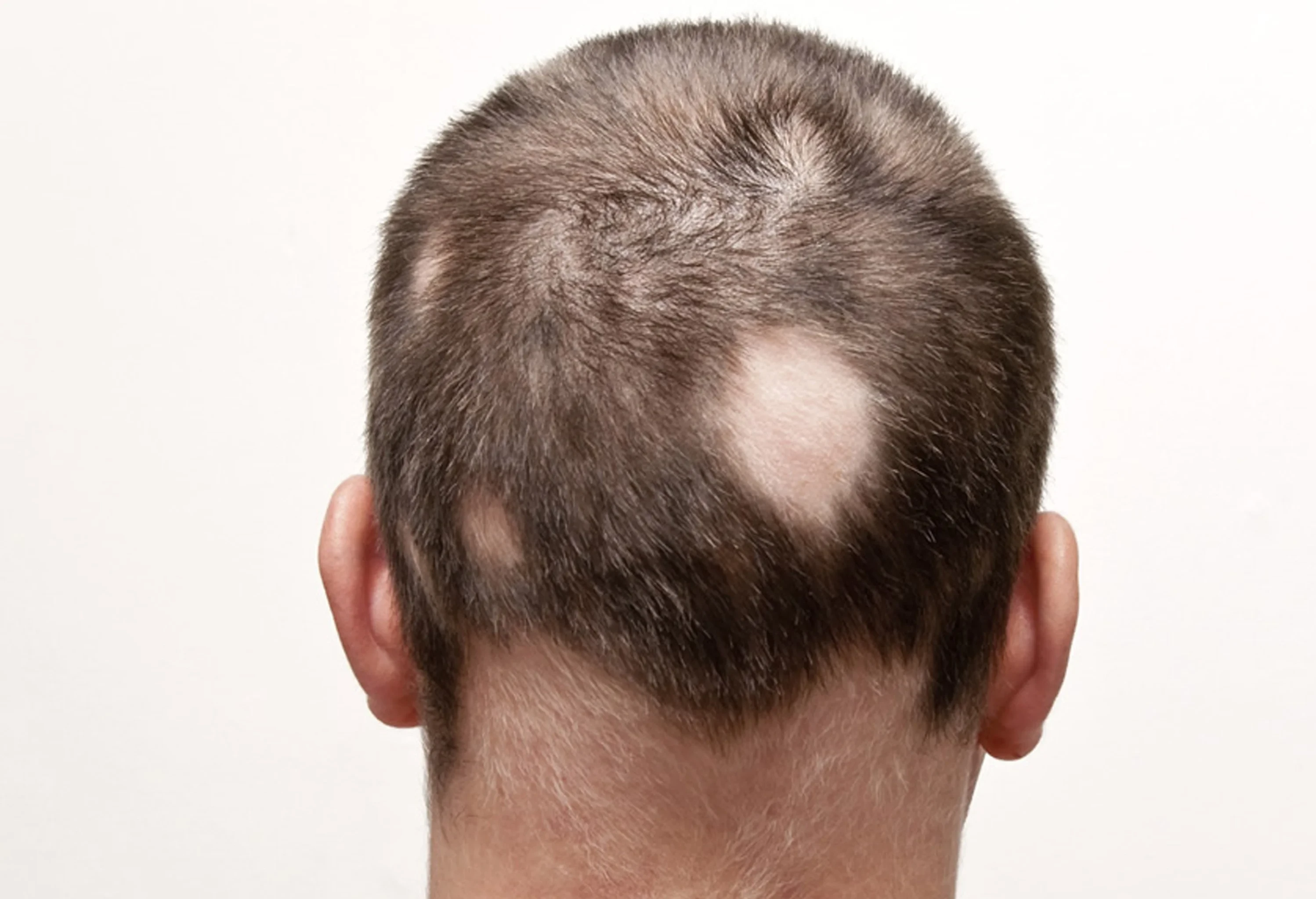 Living With Alopecia Areata