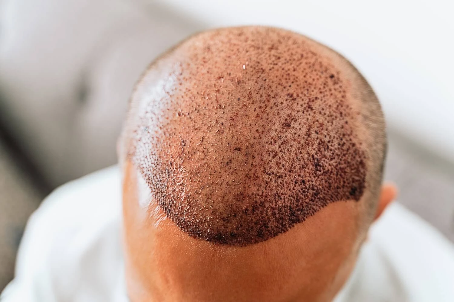 Scabbing After Hair Transplant: Timeline, Washing and Safe Removal