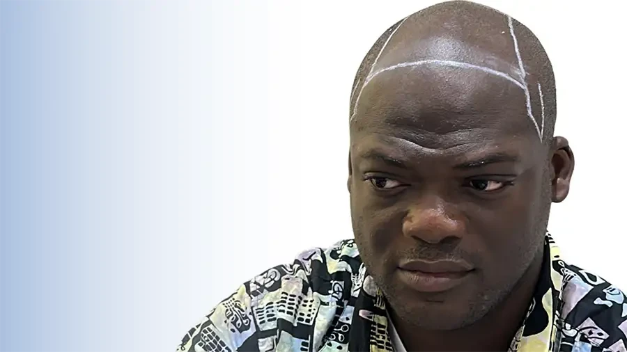 Long Hair FUE for Afro-Textured Hair