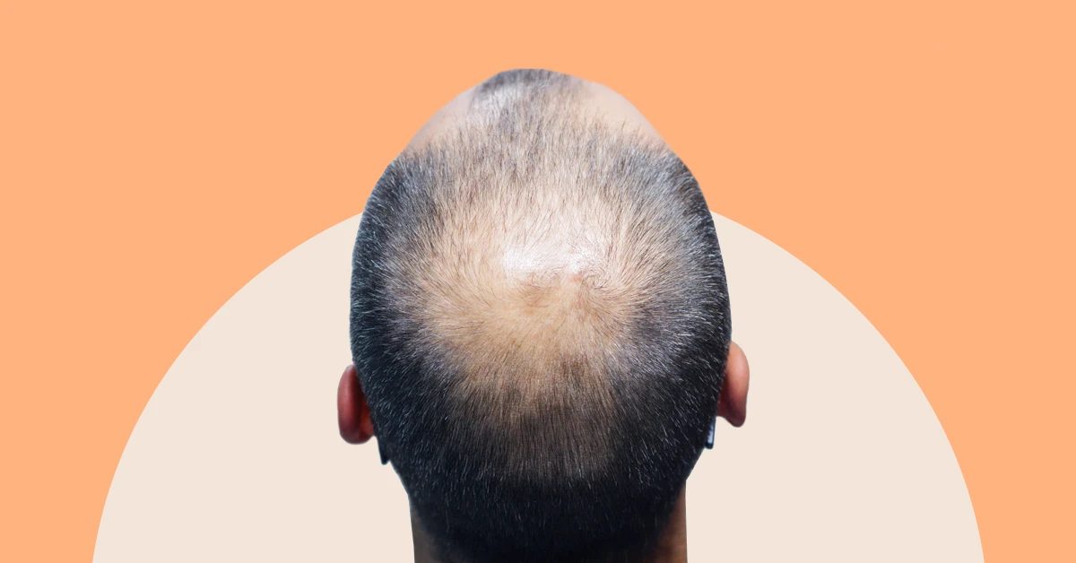 Androgenetic Alopecia: Causes, Symptoms, Diagnosis and Treatment