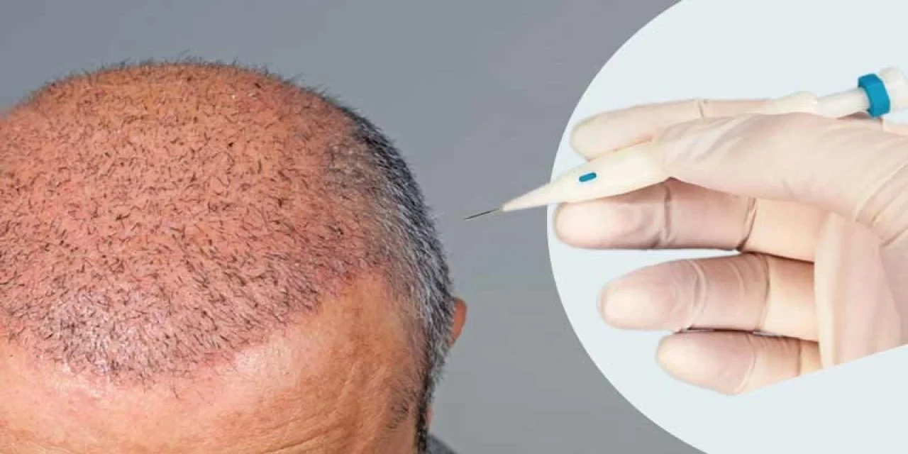 Is FUE or DHI Better? Key Differences Explained