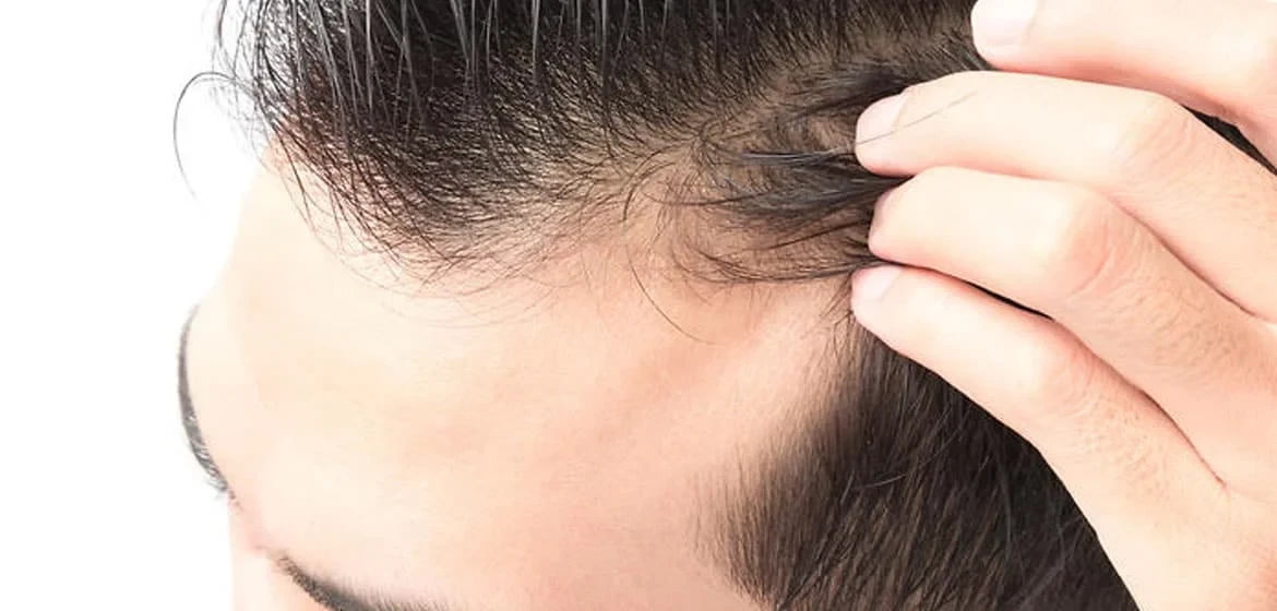 Why Is My Hairline Receding Faster on One Side?