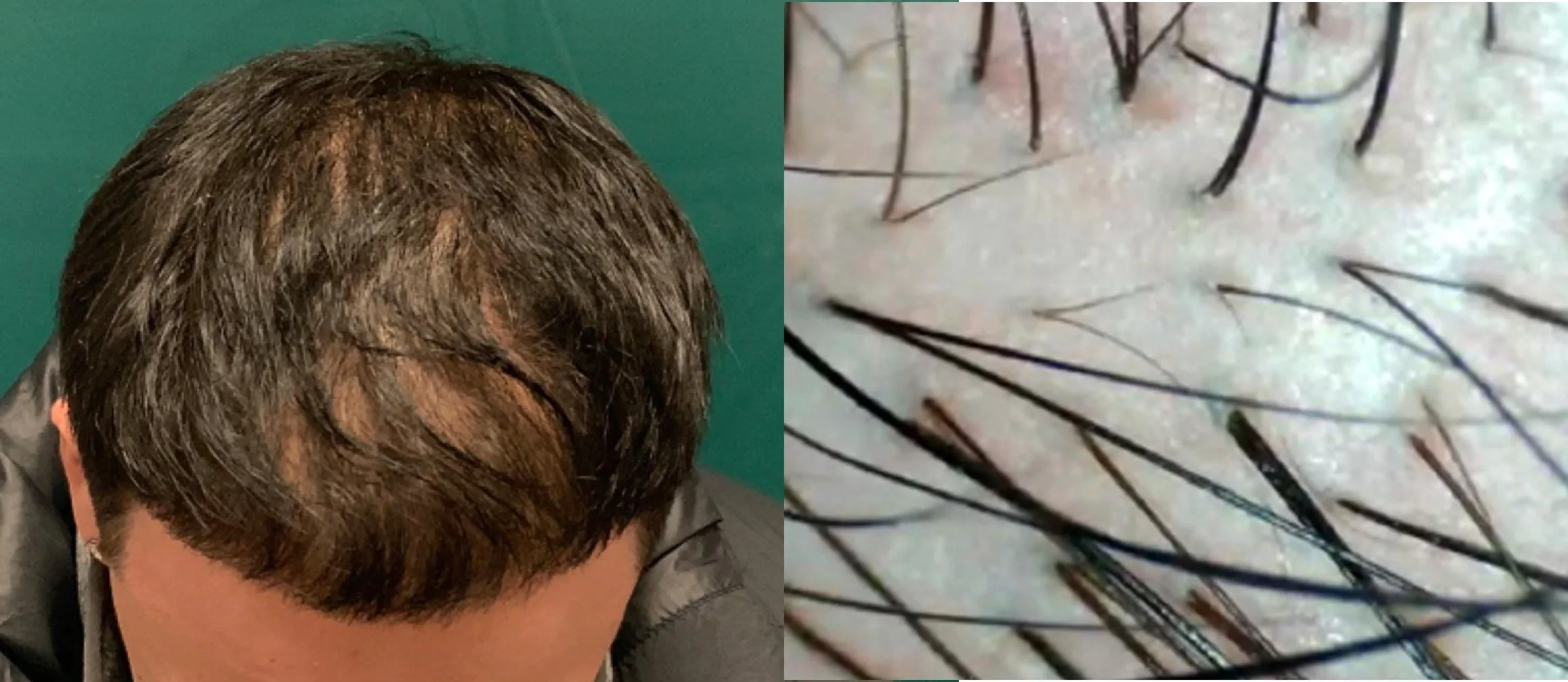 Telogen Effluvium: Causes, Duration and Treatment