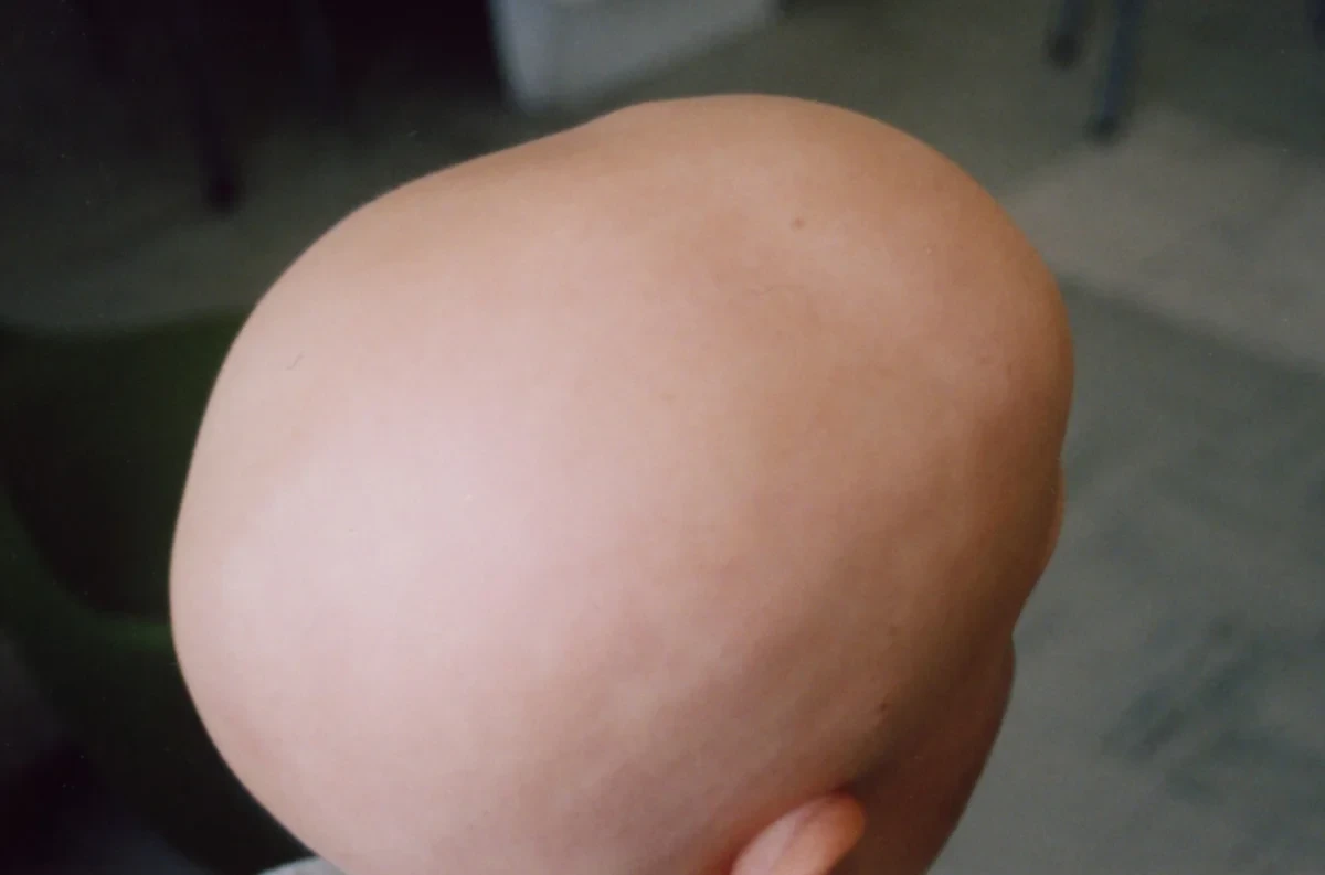 Alopecia Totalis: Causes, Symptoms, Treatment, and Hair Regrowth