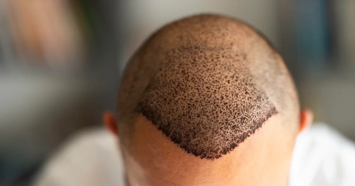 Does Long-Distance Travel Affect Hair Transplant Recovery?