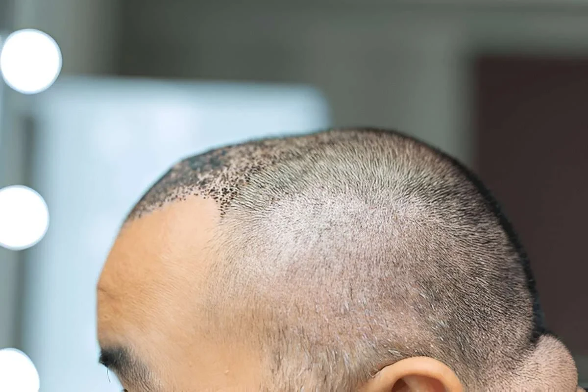 First 10 Days After a Hair Transplant