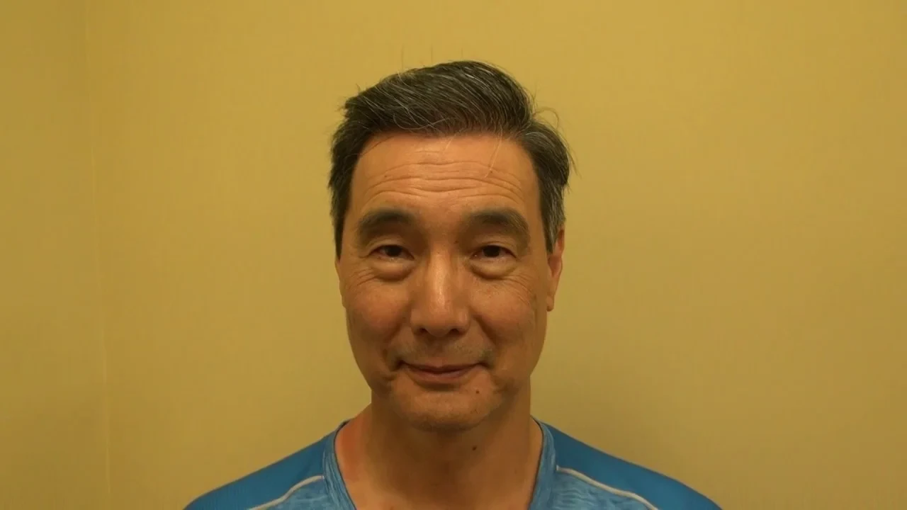 Hair Transplant for Thick Asian Hair