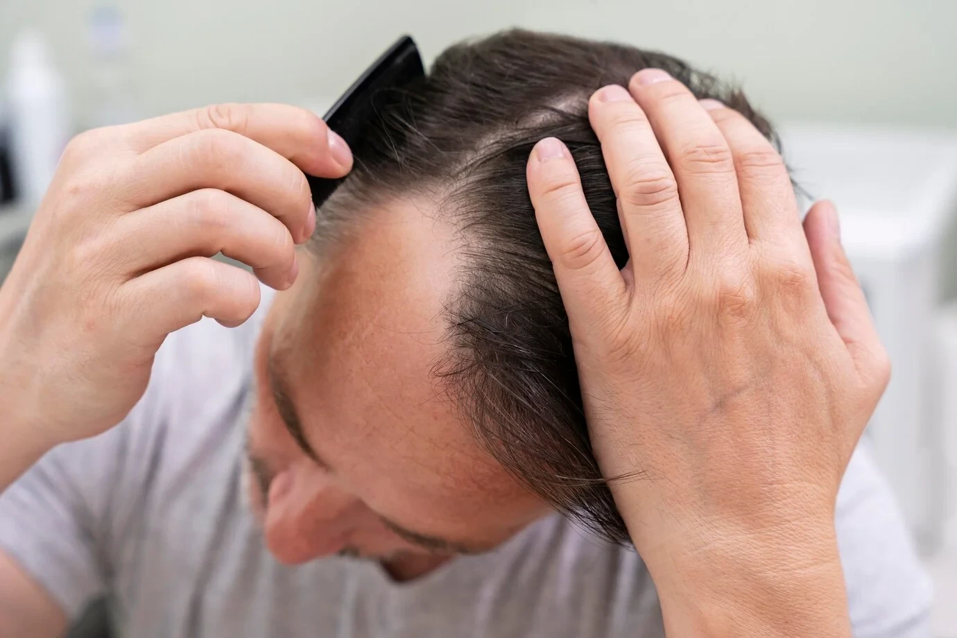Hair Loss After Ozempic, Wegovy or Mounjaro