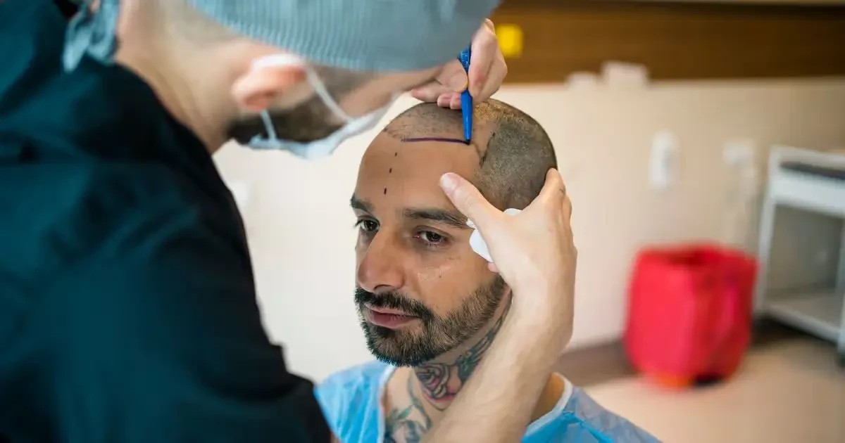 Hair Transplant for Latino Hair Types