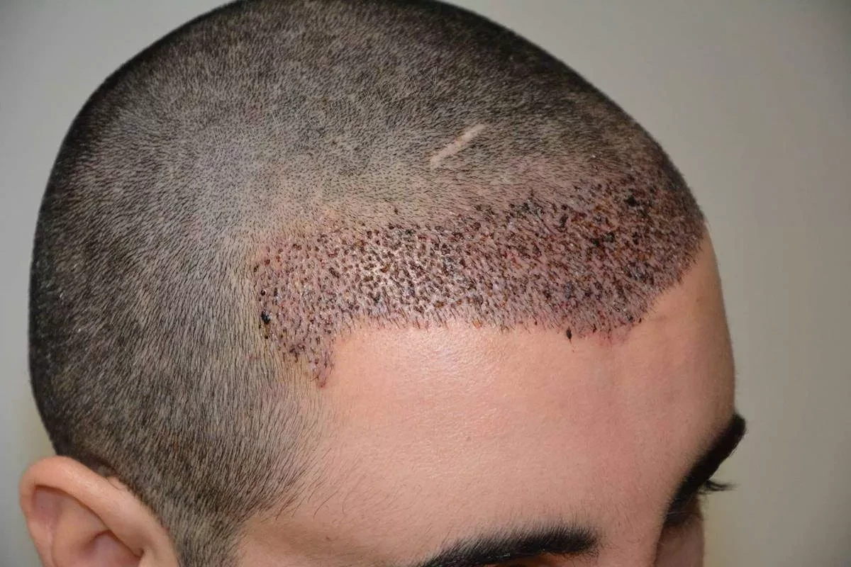 Hitting Your Head After Hair Transplant