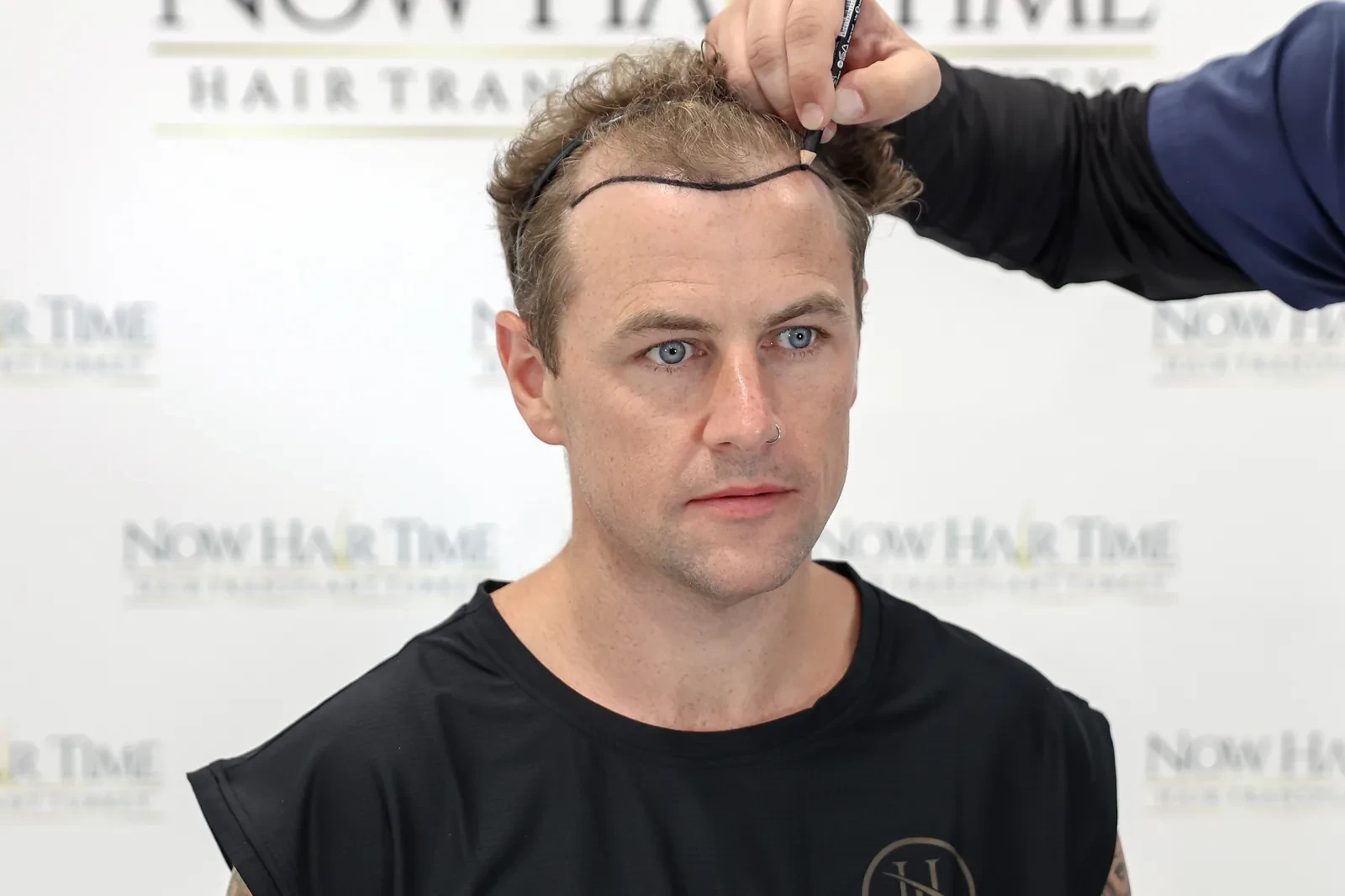 hair transplant in istanbul